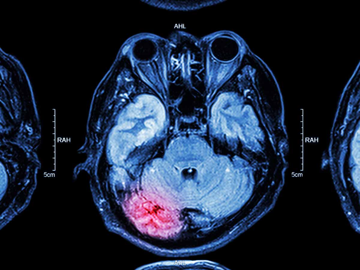 long-term-effects-of-a-ttbi-key-information-to-know